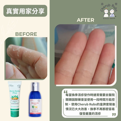 十年慢性濕疹患者