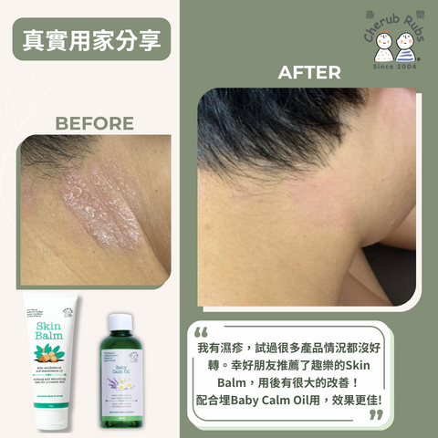 飽受濕疹困擾的客人